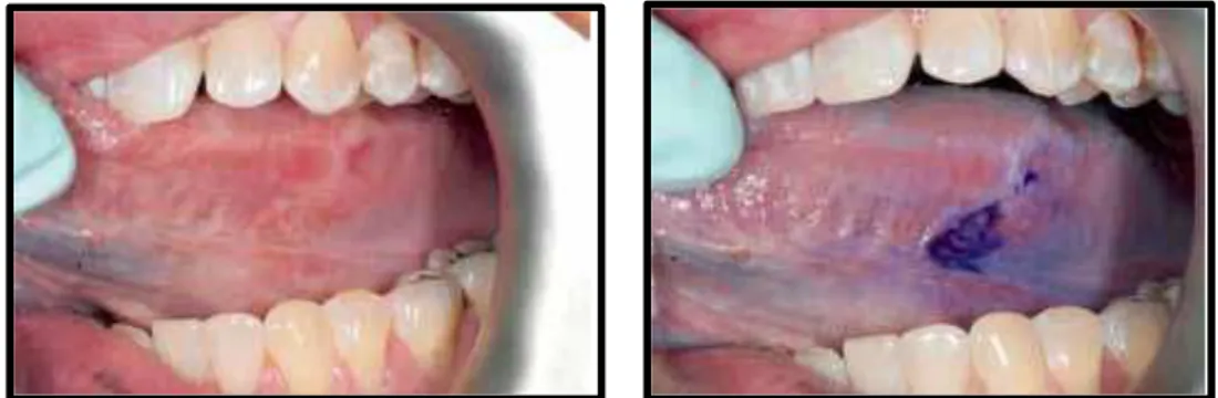 Figura 11 - Coloração de uma lesão suspeita com TB no bordo lateral da língua  (Kerr &amp; Shah, 2013) 