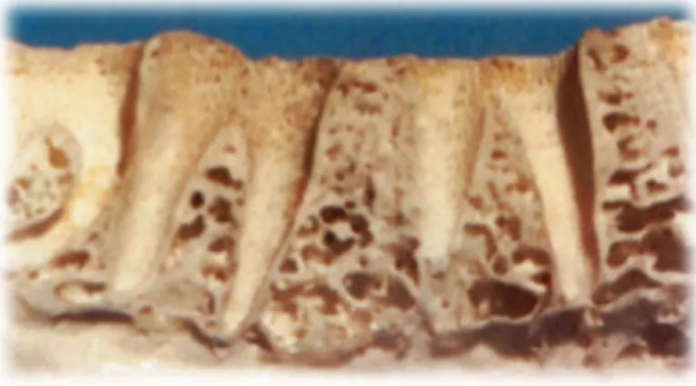 Figura  4  –  Imagem  de  corte  sagital  de  alvéolos  dentários,  onde  se  pode  observa  as  placas  cribriformes  (Adaptado de Misch, 2008)