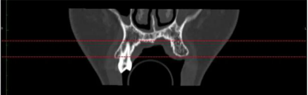 Figura 15 – Linhas de referência indicativas dos limites axiais do defeito ósseo. 