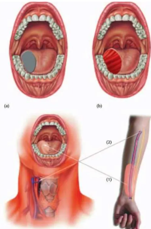 Figura 13- Hemiglossectomia com reconstrução radial do retalho do antebraço. (A) O tumor da língua que  requer tratamento cirúrgico