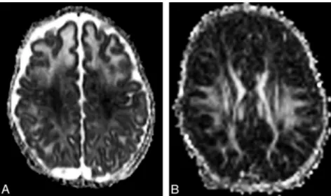 Fig 1. A, Apparent diffusion coefficient (ADC) map demon- demon-strates decreased signal intensity in the perirolandic white matter and centrum semiovalia