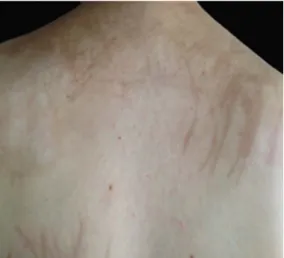 Figure 1 Multiple curvilinear brownish hyperpigmented streaks, scattered throughout her upper trunk.