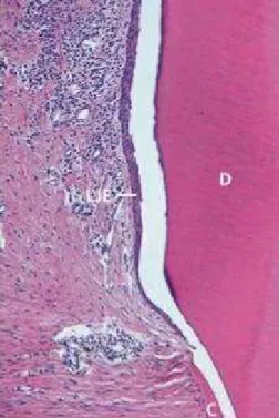 Figura 2 - Imagem histológica microscópica ilustrativa da formação de um epitélio juncional longo (LJE) a  terminar na porção coronal de cimento regenerado (C)