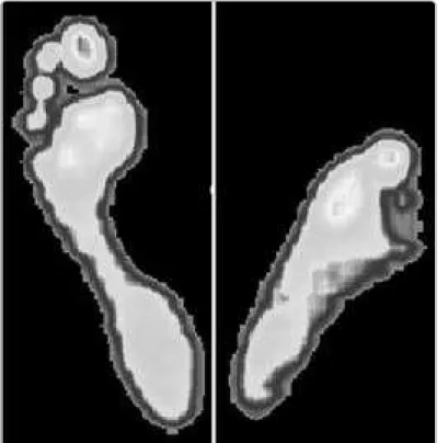 Figura 2 - Baropodografia computorizada estática mostrando assimetria da área de distribuição das pressões plantares.