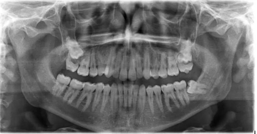 Figura 4- Ectopia dos dentes 18,28,38 