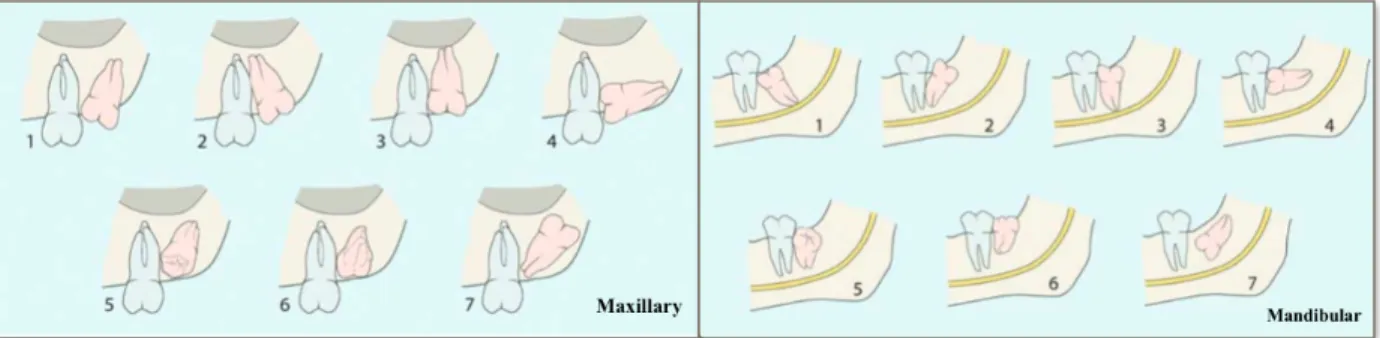 Figure  1  :  Classification  of  impaction  of  third  molar  according  to  Archer  (1975)  and  Kruger  (1984)