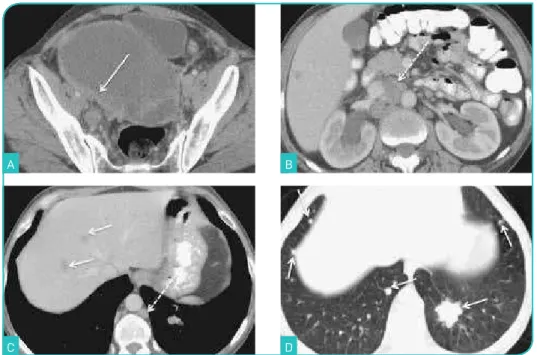 Figura 8. Carcinoma seroso bilateral do ovário em estádio IV. Imagens de TC após  administração de contraste endovenoso no plano axial (A-D)
