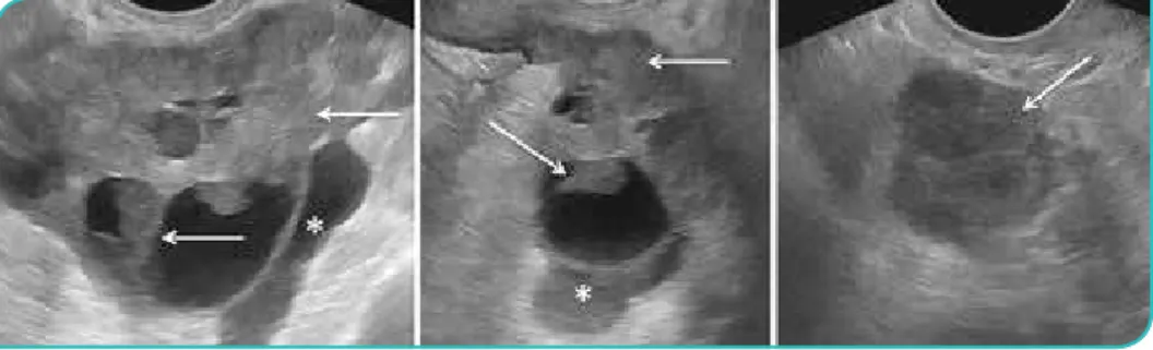 Figura 1. Carcinoma seroso bilateral do ovário numa mulher com 65 anos. Imagens de  ecografia pélvica por via supra-púbica