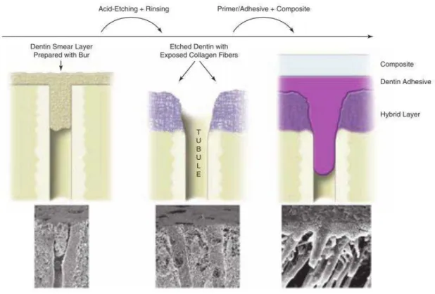 Figura 6 - Processo de adesão à dentina utilizando um sistema adesivo etch-and-rinse  (Fonte: Perdigão et  al., 2002)