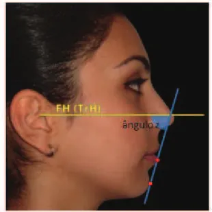 Figura 7- Linha Z Merrifield. 