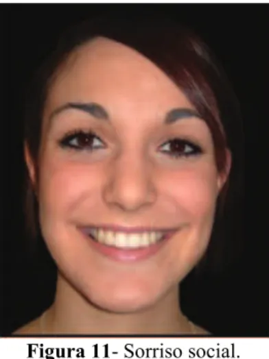 Figura 11- Sorriso social. 