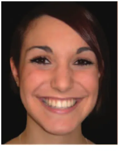 Figura 12- Sorriso emocional.  