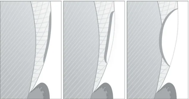 Figura 1 – Diferentes estágios no processo erosivo: amolecimento inicial do esmalte (sem perda de  substância) (esquerda), perda de substância (desgaste erosivo) e amolecimento da superfície subjacente 