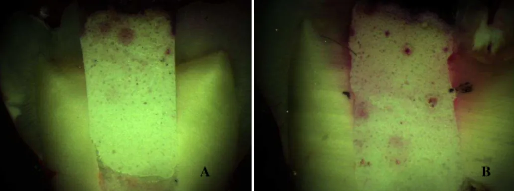Fig. 10. Restauração com Tempit® (Centrix) (G3) -Com grau 1 (A) e grau 2 (B) para a microinfiltração  marginal 