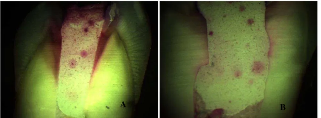 Fig. 13. Restauração com Tempit® (Centrix) (G3) - Com grau 2 (A) e grau 3 (B) para a microinfiltração  marginal 