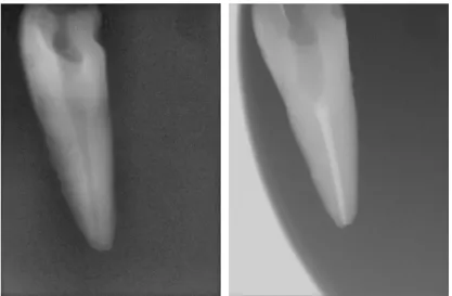 Figura 11- Exemplo duma imagem de raio x inicial e final. Estas imagens  pertencem à amostra 48.