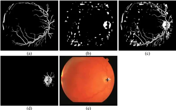 Fig. 5. (a) Vessel segmented image; (b) intensity candidates; (c) combination of (a) and (b); (d) circular region around estimated OD; (e) original retinal image with final (black cross) and estimated (white cross) OD positions.