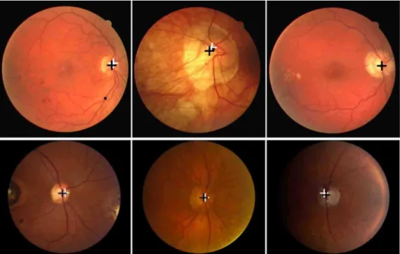 Fig. 6. Six original images with the initial estimation after the first phase of the algorithm (white cross) and the final OD location (black cross)