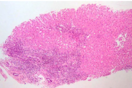 Figure 2 In ﬂ ammatory lymphoplasmacytic in ﬁ ltrate in portal areas and severe interface hepatitis.