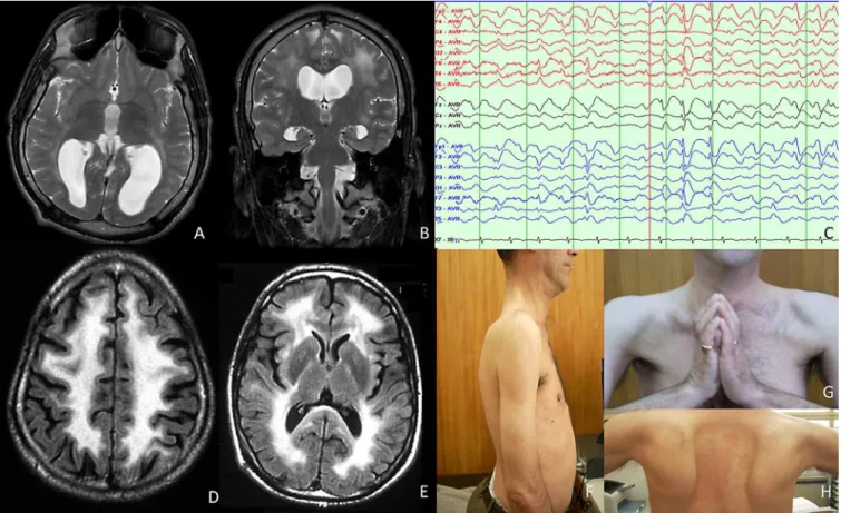 Fig. 1. T2-weighted axial (A) and coronal (B) brain MRI of patient 1 at age 15; note the occipital agyria and white matter hyperintensity; (C) EEG of patient 1: diﬀuse slowing of background activity; bilateral paroxysms, stronger in the anterior regions