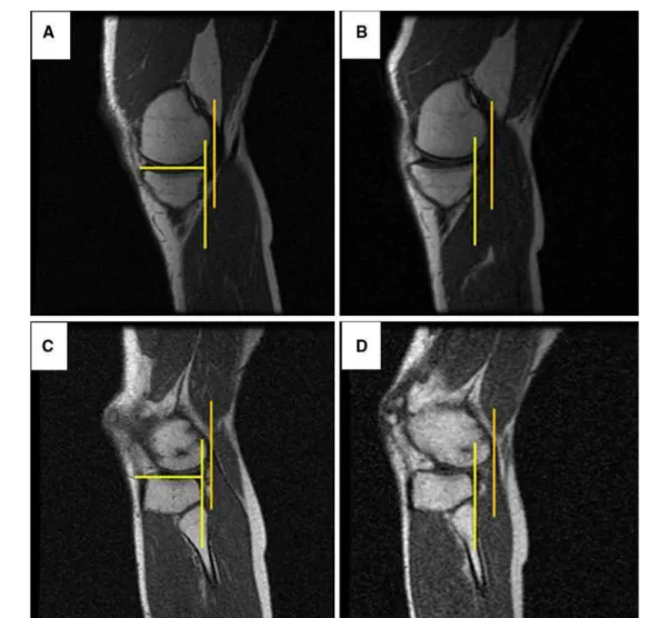 Fig. 2 MRI images of injured knee for medial compartment without (a) and with pressure (b), and for lateral compartment without (c) and with pressure (d), obtained using the PKTD