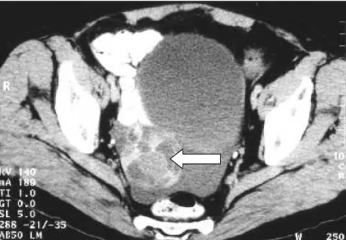 Fig. 19 - RM pélvica: struma ovarii do ovário direito (seta). Presença de ascite. a) Ponderação em T1: as áreas quísticas são hipointensas
