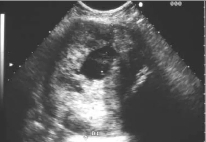 Fig. 20 - Ecotomografia ginecológica transvaginal: carcinóide do ovário.