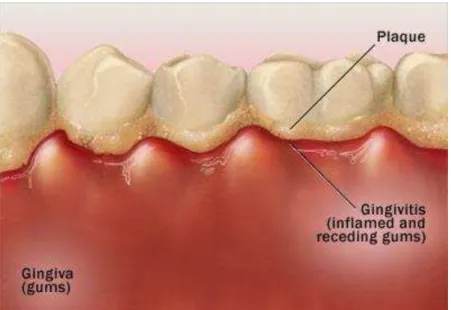 Figure 4:  “ Gingivitis can cause dusky red, swollen, tender gums that bleed easily” (Mayo Foundation for  Education and Research, n.d.) 