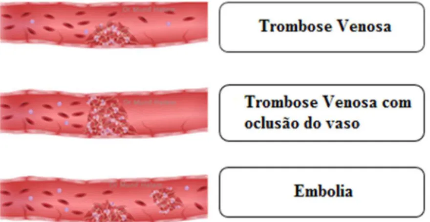 Figura 3 - Tromboembolismo venoso (adaptado de www.mundoeducacao.com/doencas/trombose.htm).