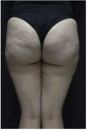 Figura 1. Aspeto clínico da celulite. 