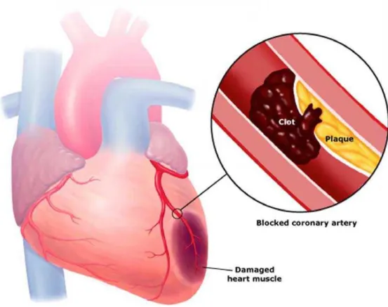 Figura 5 – Formação de um coágulo após ruptura da placa aterosclerótica ao nível do coração (Carreras 