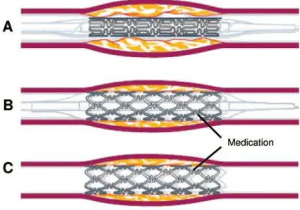 Figura 6 – Colocação de um stent farmacológico numa artéria coronária (Maisel &amp; Laskey, 2007) 