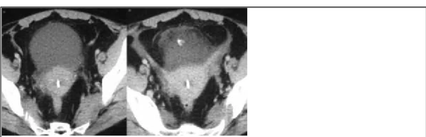 Figure 1 Contrast enhanced pelvic CT