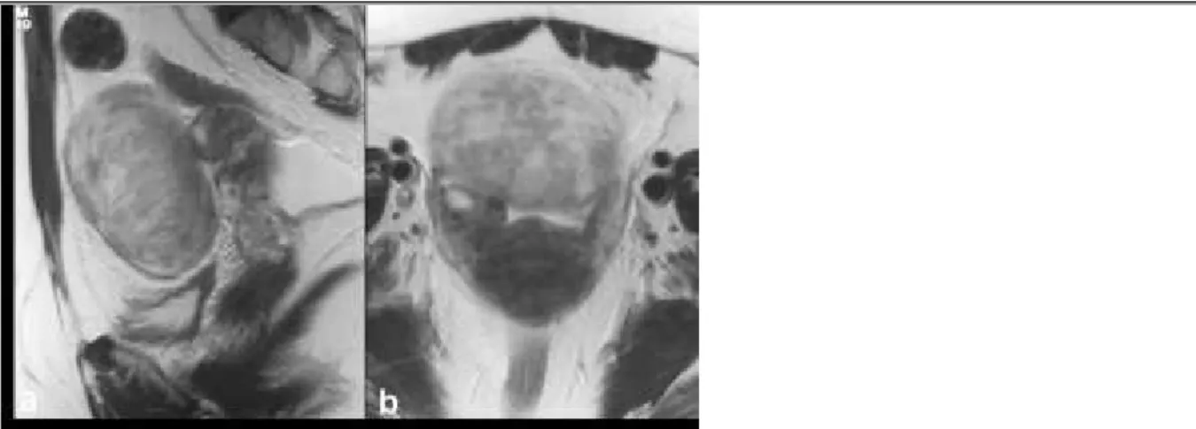 Figure 3 Pelvic MR