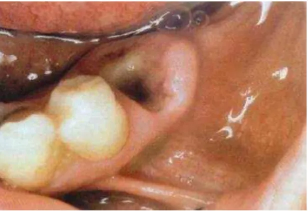 Figura 3 - Aspeto clinico da alveolite seca  (Escoda &amp; Aytés, 2004) 