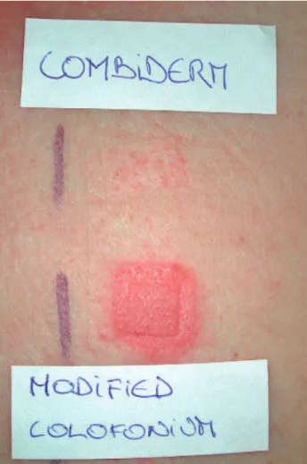 Fig. 2. Positive patch tests to both Combiderm 1 and glyc- glyc-eryl rosinate (modified colophonium).