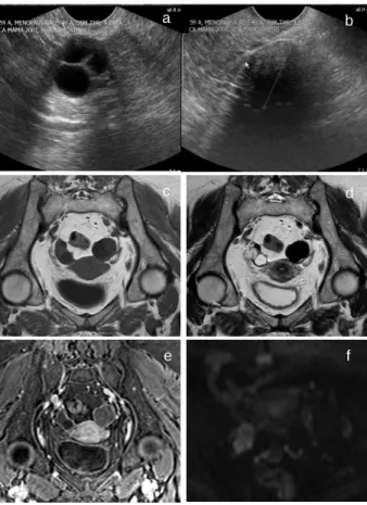 Fig.  10  -  Carcinoma  endometrióide  do  ovário  direito.  Ecotomografia transvaginal  com  modo  Doppler  (a)