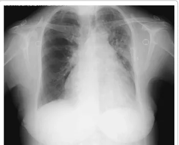 Figure 3 Chest angio-computed tomography revealing hypoplasia/agenesis of the right pulmonary artery (white arrows) and hyperinflation of the pulmonary parenchyma (red arrows).