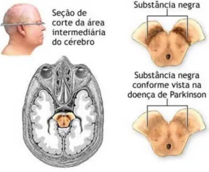 Figura 1- Corte cerebral num cérebro sem DP e noutro com DP (Adaptado de Bravo &amp; Nassif, 2006)