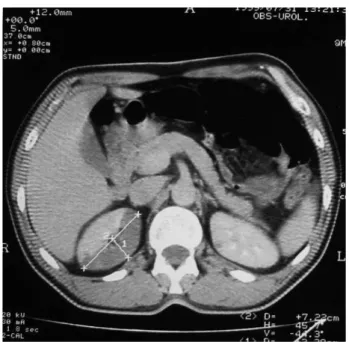 FIGURE 1. TAC renal 
