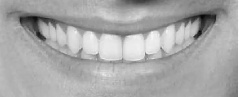 Figura 5- Arco do sorriso ideal. A curvatura dos bordos incisais dos dentes superiores acompanha a  curvatura do lábio inferior