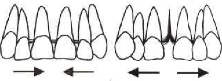Figura 10- Disposição das fibras transeptais no diastema incisivo. Na figura à esquerda observa-se o  arranjo normal das fibras transeptais e na figura à direita observa-se a invaginação das fibras transpetais 