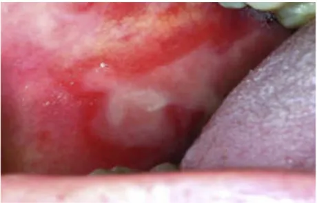 Figura 2. Lesão de MO na mucosa oral 