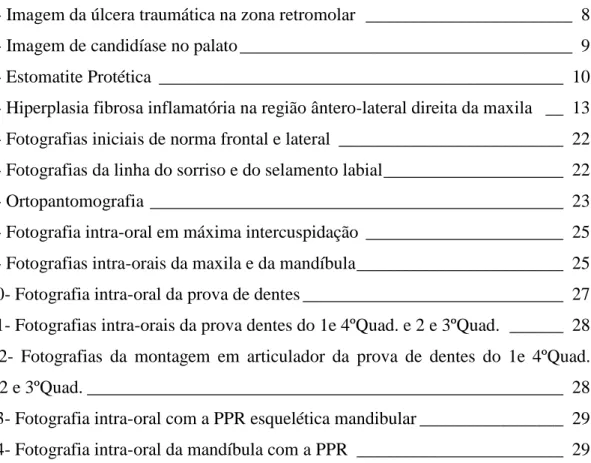 Fig. 1- Imagem da úlcera traumática na zona retromolar  _______________________  8  Fig