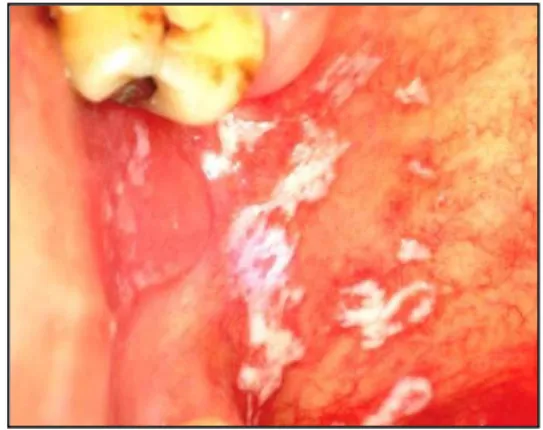 Fig. 2- Imagem de candidíase no palato (Sebástian, 1999, p.1) 