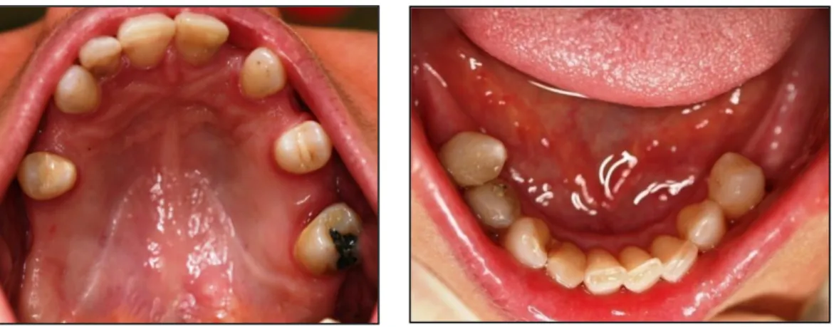 Fig. 9- Fotografias intra-orais da maxila (à esquerda) e da mandíbula (à direita) 
