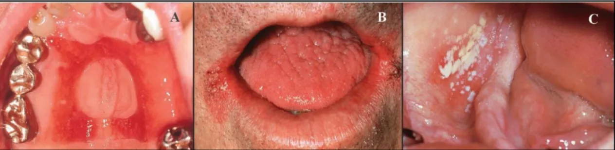 Figura 8. A: Estomatite protética. B: Queilite angular. C: Candidíase pseudomembranosa aguda
