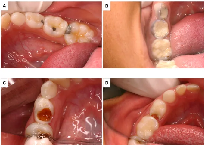 Figura 4 Fotografias de dentes molares decíduos de crianças inseridas no estudo clínico do Paranoá