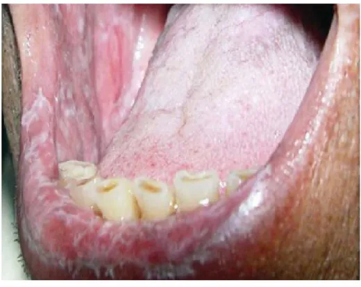 Figura 1: Líquen plano reticular – aspecto reticular zona do lábio inferior e mucosa  jugal