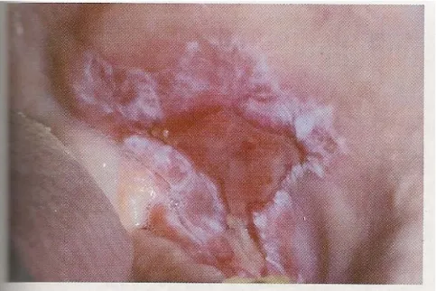 Figura 7: Líquen plano: A ulceração da mucosa jugal exibe estrias ceratóticas  periféricas radiantes, características do líquen plano erosivo oral